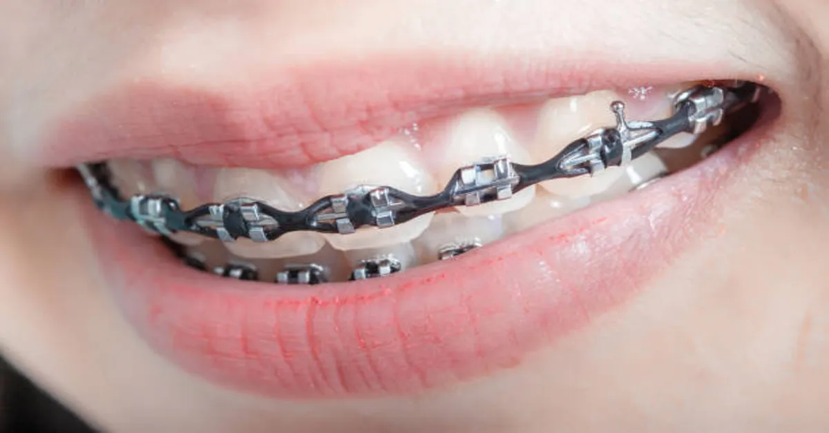 Power Chain Braces